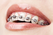 The image shows a close-up of a person s mouth with braces and a smile, against a blurred background.